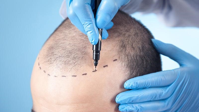تبلیغ کاشت مو؛ نمونه متن پیام تبلیغاتی + اصول نگارش