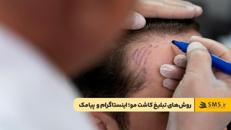 تبلیغ کاشت مو در اینستاگرام و پیامک